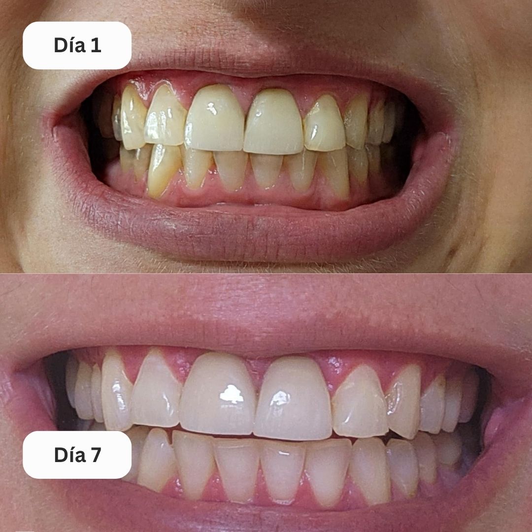 SonrisaPro™ - Kit que Ilumina tu Sonrisa